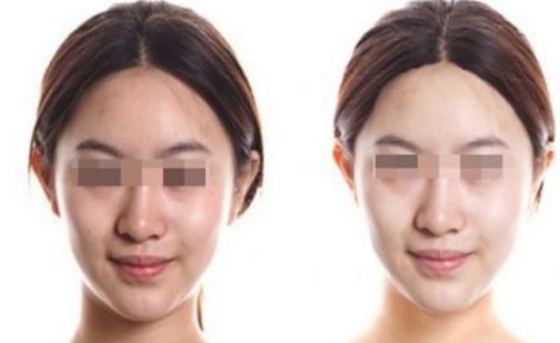 武漢皮膚科祛斑治療效果好在哪？名醫(yī)推薦+祛斑真實案例分享