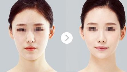 鄭州哪家醫(yī)院比較好做唇部整形？