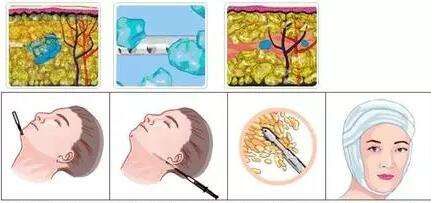 哈爾濱醫(yī)科大學(xué)附屬一院植發(fā)價格查詢及專家預(yù)約攻略