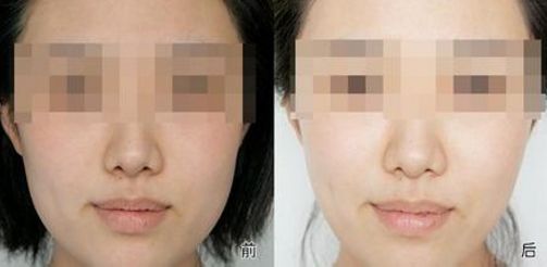 【揭秘】成都雙眼皮醫(yī)院最佳選擇，眼部微創(chuàng)手術(shù)秘訣大公開！