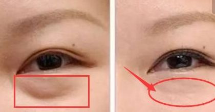 上海楊亞益雙眼皮修復(fù)技術(shù)解析，案例分享全文解讀