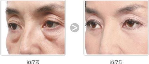 長(zhǎng)沙哪家醫(yī)院做隆胸好？專家推薦！