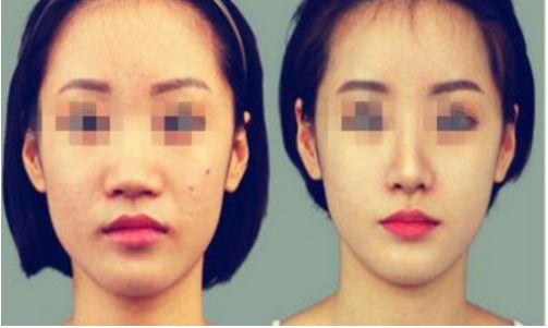 贛州哪家醫(yī)院的鼻部整形好？