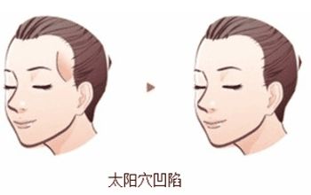 蘇州美貝爾與美萊：隆鼻比較！價(jià)格與特色對(duì)比！