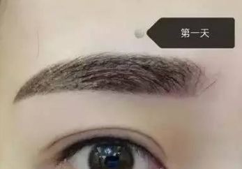 馮斌自體脂肪豐胸效果如何？案例分享給您