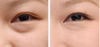 武漢愛思特整形醫(yī)院值得信賴嗎？專家團隊丨磨骨案例丨最新報價