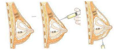 深圳肖東興醫(yī)生雙眼皮手術(shù)出色，讓你煥然一新！80天前的成功案例重磅揭曉！