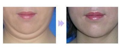 成都友誼醫(yī)院整形科優(yōu)秀醫(yī)師推薦：全臉脂肪填充效果如何？