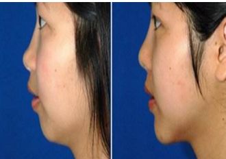 長春銘醫(yī)整形注射哪位醫(yī)師技術(shù)精湛？專家推薦與費(fèi)用一覽