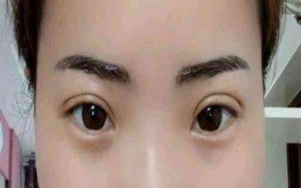 丁硯江填充脂肪的效果如何？為什么該方法備受推崇？