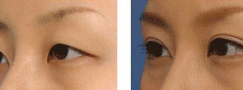 上海九院凸嘴手術(shù)費用高昂？手術(shù)技術(shù)如何？推薦醫(yī)生參考