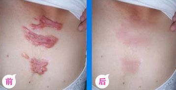 九院脂肪填充，醫(yī)生技術(shù)高超，詳細(xì)價格表揭曉