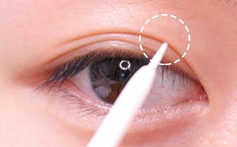 成都成美整形醫(yī)院的脂肪溶解術(shù)成功案例公開