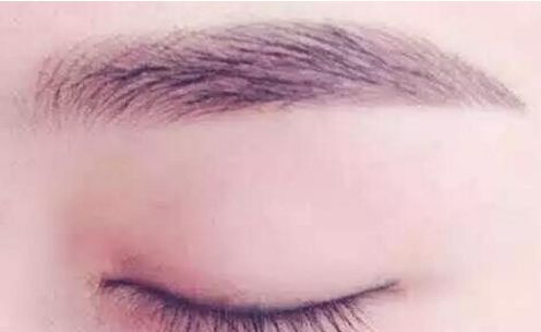 深圳美萊面部脂肪填充技術(shù)：醫(yī)師團(tuán)隊案例詳解