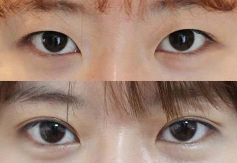 廣州曙光整形醫(yī)院的鼻部整形效果如何？收費(fèi)如何？真實(shí)案例分享！