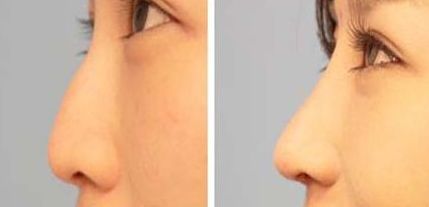 長春最可信賴的自體脂肪豐胸醫(yī)院，專業(yè)可靠的推薦