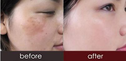 如何選擇適合自己的雙眼皮手術(shù)方式