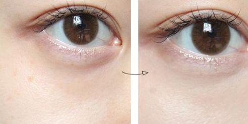 德陽(yáng)王亞國(guó)雙眼皮修復(fù)90天體驗(yàn)細(xì)節(jié)圖分享