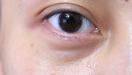 【重慶】銅雀臺雙眼皮醫(yī)生技術對比，伍森林、王杰醫(yī)、梁海彬誰更厲害？