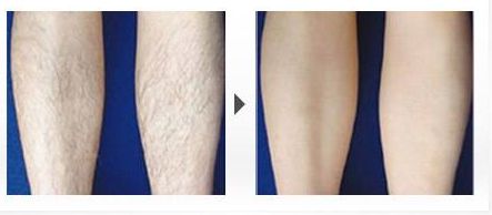 脂肪豐額頭手術(shù)的效果如何？了解專家的分享