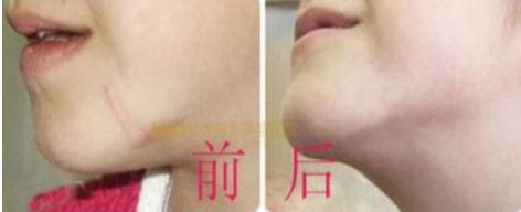 長沙最佳吸脂手術(shù)醫(yī)院排名，雅美、華韓華美、鵬愛等值得借鑒的評價