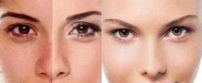 溫州陳熙醫(yī)生精湛技藝解決眼袋問題