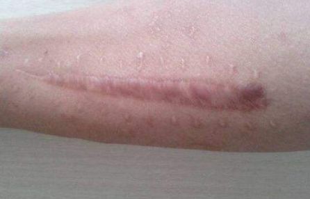 北京藝星白書白師傅，2023獨(dú)家案例揭秘：雙眼皮手術(shù)讓你閃耀美麗！