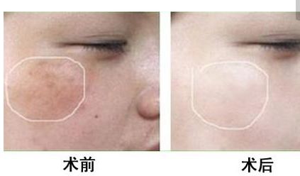 長沙美田芳斌雙眼皮讓你驚艷！令人難忘的改變來襲！