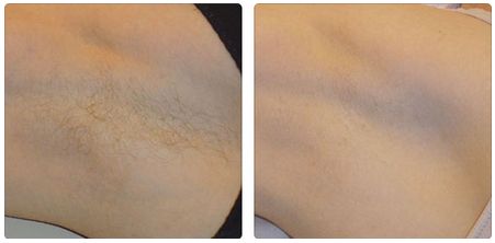 吳氏嘉美的雙眼皮做得好嗎？真實(shí)口碑曝光，價(jià)格查詢附上！