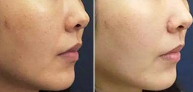 八大處王佳琦醫(yī)生獨家技術(shù)！驚艷去眼袋，50天展示成果震撼！