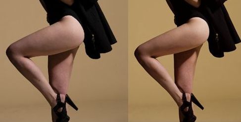 蘭州亞韓整形醫(yī)院的雙眼皮手術(shù)效果如何？親身體驗(yàn)分享+手術(shù)案例解析