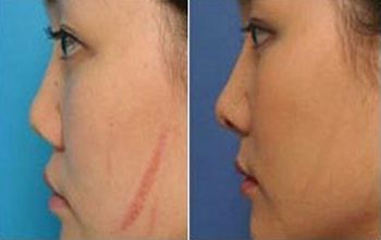 廣州眼部整形三甲醫(yī)院雙眼皮手術(shù)最新排行榜發(fā)布