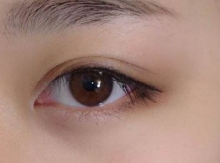 杭州任東做鼻部整容效果如何？MD技術解析真實案例分享！