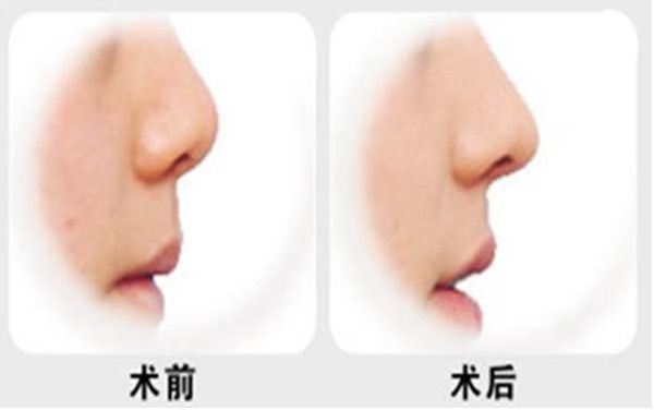 燕雄鼻子整容結(jié)果亮相！專家實力和成功案例揭秘
