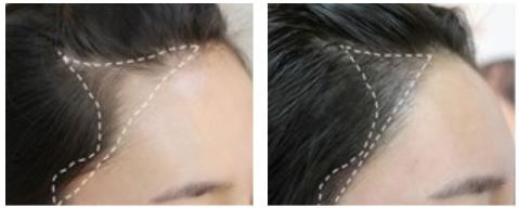 西安丁合軍的鼻子修復(fù)效果如何？90天真實(shí)案例分享