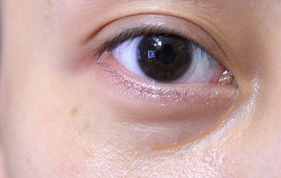 重慶美萊鄭楠醫(yī)生眼部整形術(shù)情況、資料及價(jià)格請(qǐng)參考