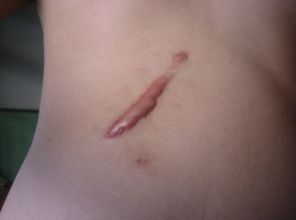 滄州靜港醫(yī)院雙眼皮手術效果如何？哪位醫(yī)生值得信賴？手術費用參考表同步分享