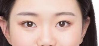 山東省立醫(yī)院整形外科激光祛斑真的有效嗎？