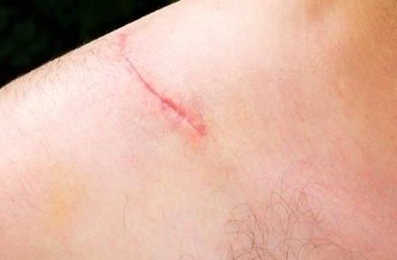 八大處張超面部吸脂效果解析：醫(yī)生技術(shù)實力、案例與價格