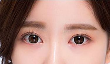 鄭州葛艷娜雙眼皮整形技術(shù)及真實案例分享