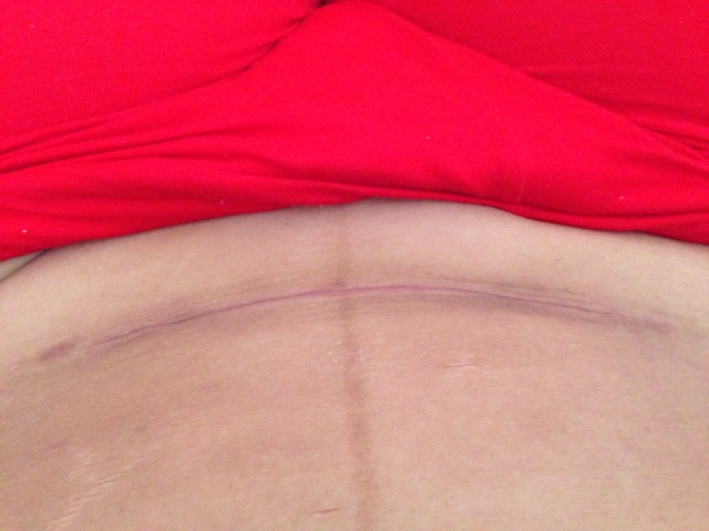 如何避免自體脂肪注射豐胸的風(fēng)險(xiǎn)？務(wù)必掌握這些關(guān)鍵信息