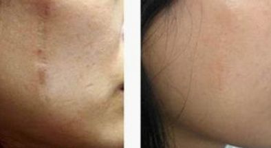 國內(nèi)有哪些值得推薦的磨骨權(quán)威專家？優(yōu)秀磨骨師張笑天、李志海等值得關(guān)注