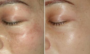 李天石做眼皮手術(shù)費(fèi)用昂貴？個(gè)人體驗(yàn)分享：三個(gè)月改變！