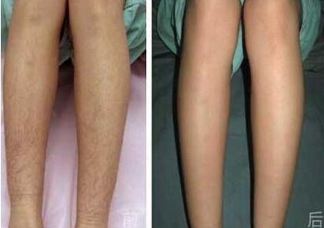 溫州自體脂肪隆鼻哪家醫(yī)院靠譜？熱門醫(yī)院推薦排行榜揭曉！