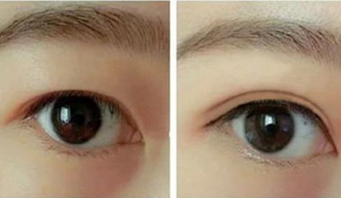 李世榮隆鼻的效果如何？西南醫(yī)院醫(yī)生經(jīng)典案例揭秘