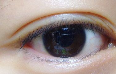 健麗整形醫(yī)院的去眼袋效果如何？2023患者分享案例！