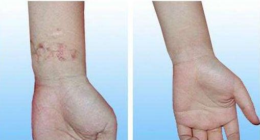 柴云醫(yī)生做雙眼皮后亮麗綻放！欣賞真實(shí)案例，驚艷非凡的視覺效果！