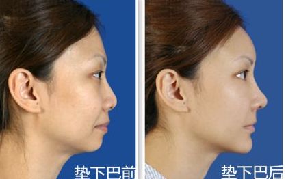 上海九院鼻部整形手術(shù)專家李圣利，專業(yè)水準如何？