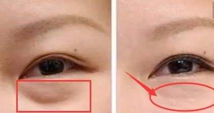 揭秘昆明雙眼皮明星醫(yī)生！驚喜榜單出爐，內(nèi)有杜海寬、王靜等大咖名醫(yī)！