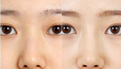 專業(yè)排行榜出爐！北京最頂級(jí)雙眼皮醫(yī)生名單公布！